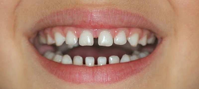 Bị răng thưa hàm dưới phải làm sao? 1