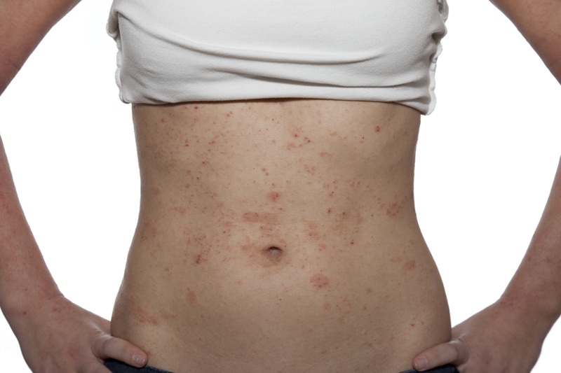 Bị rôm sảy ở người lớn: Nguyên nhân và cách điều trị 1