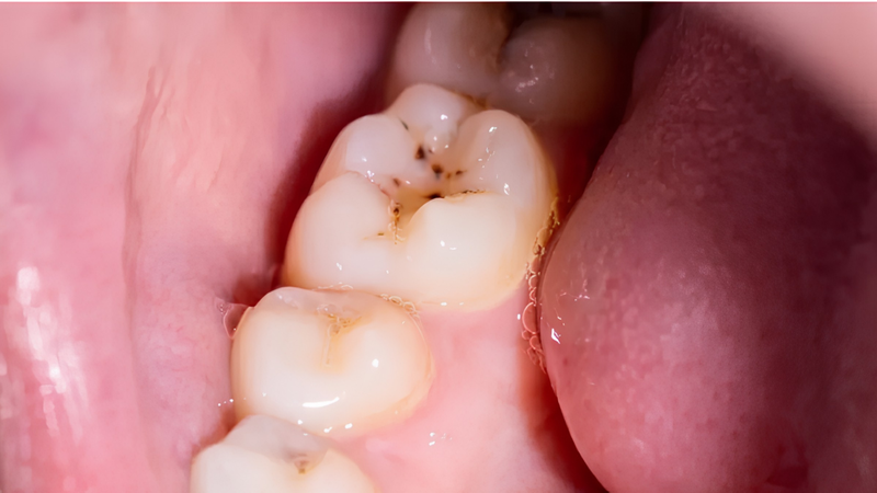 Bị sâu răng có đi Nhật được không? là thắc mắc được nhiều người quan tâm