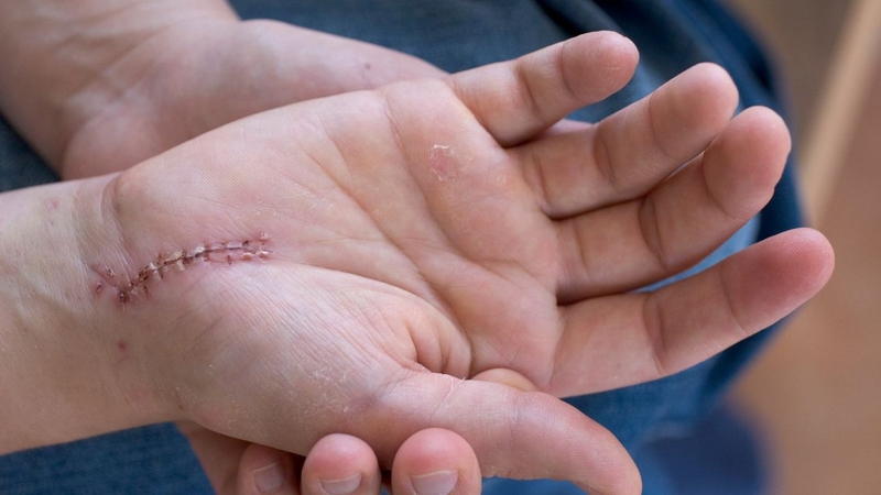 Bị sẹo kiêng ăn gì? Lời khuyên cho từng cơ địa 1