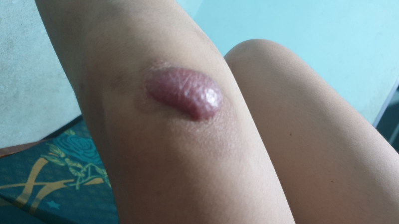 Bị sẹo lồi ở đầu gối phải làm sao? 1