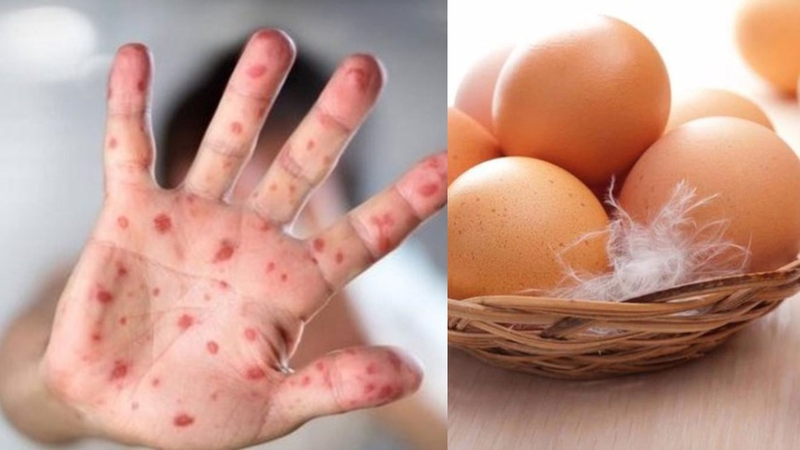 Bị tay chân miệng ăn trứng gà được không? Lời giải đáp từ phía chuyên gia dinh dưỡng 1