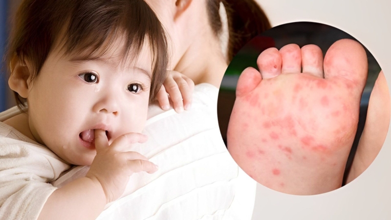 Bị tay chân miệng ăn trứng gà được không? Lời giải đáp từ phía chuyên gia dinh dưỡng 3