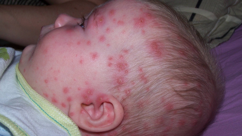 Acyclovir thường được chỉ định điều trị những bệnh như thủy đậu ở trẻ em