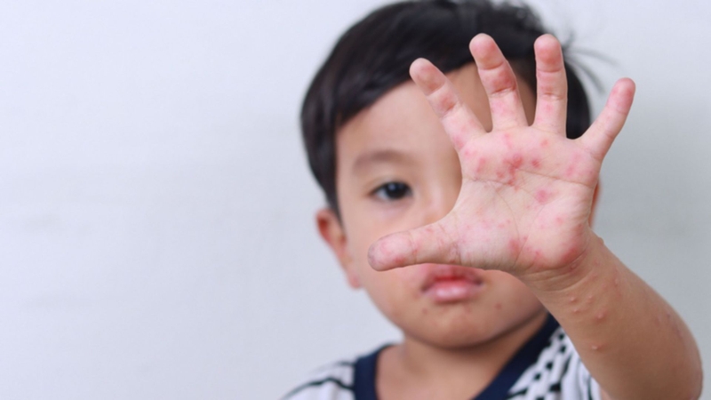 Bị tay chân miệng có ho không? Nguyên nhân và cách chăm sóc đúng cho trẻ bị ho 1