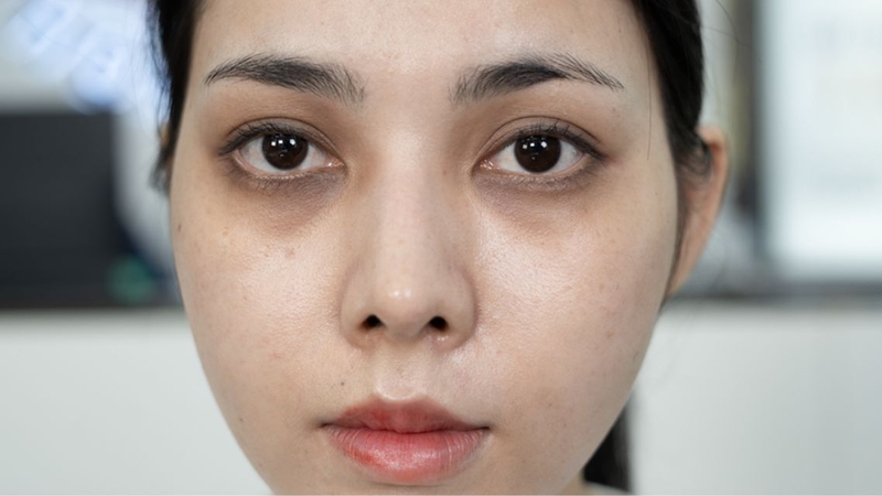 Bị thâm quầng mắt nên uống thuốc gì&nbsp;là thắc mắc của nhiều người