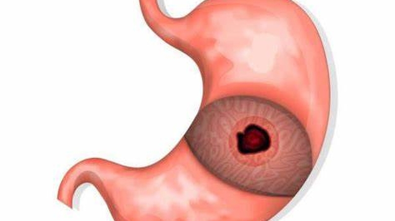 Bị thủng dạ dày có nguy hiểm không và cách điều trị như thế nào? 1