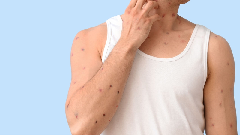 Bị thủy đậu có được ăn bún không?