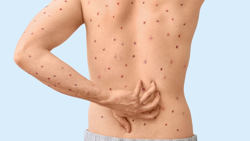 Bún mắm gây nóng rát và khó chịu cho cơ thể, không tốt khi bị thủy đậu