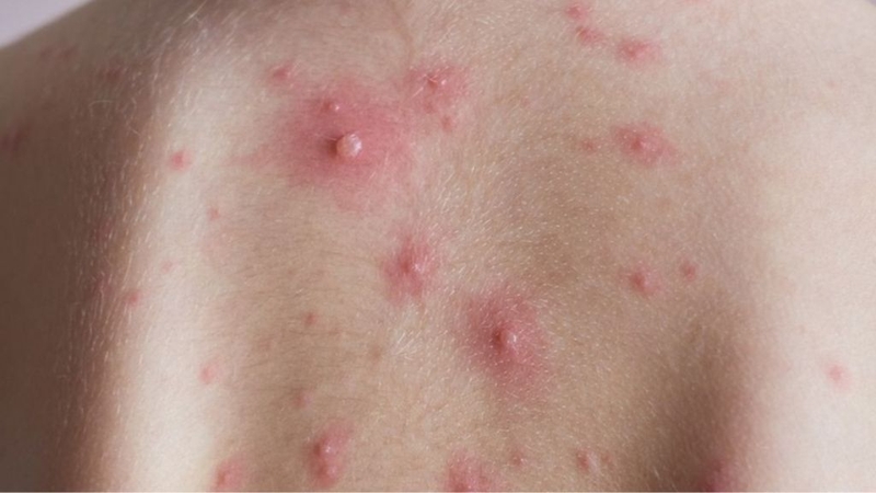 Bị thuỷ đậu có kiêng gió quạt không? Cần lưu ý những gì? 1