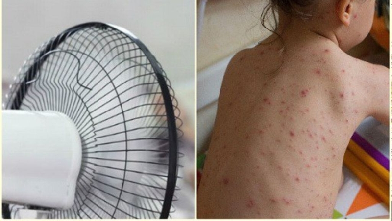 Bị thuỷ đậu có kiêng gió quạt không? Cần lưu ý những gì? 2