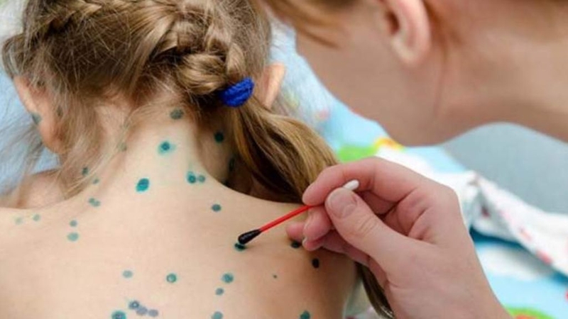 Bị thuỷ đậu có kiêng gió quạt không? Cần lưu ý những gì? 3