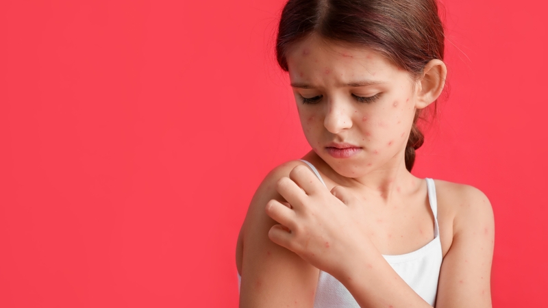 Bị thuỷ đậu có kiêng gió quạt không? Cần lưu ý những gì? 4