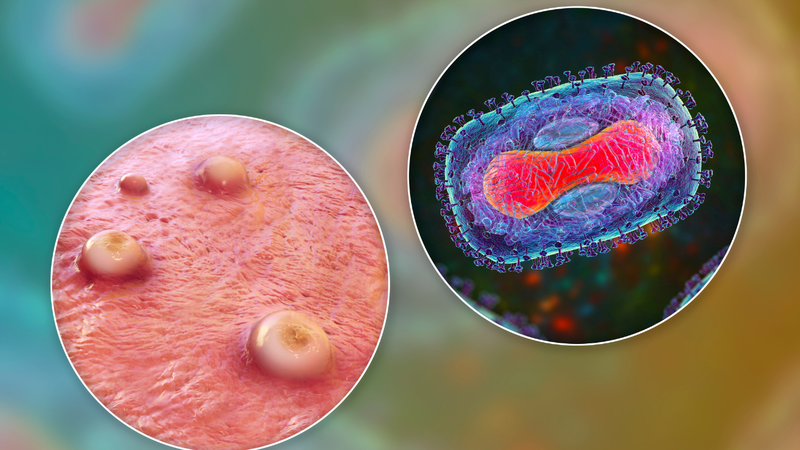 Bị thủy đậu có phải uống kháng sinh không? 2