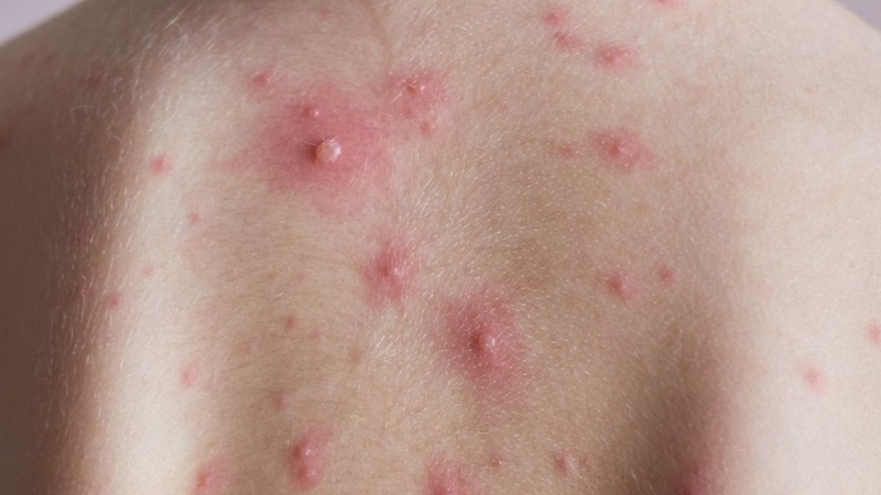 Bị thủy đậu khi mang thai 3 tháng đầu có nguy hiểm hay không? 1