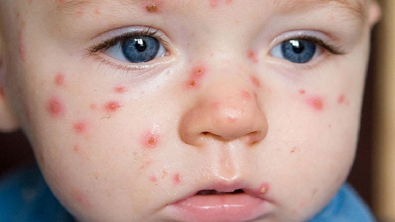 Bị thủy đậu khi mang thai 3 tháng đầu có nguy hiểm hay không? 3