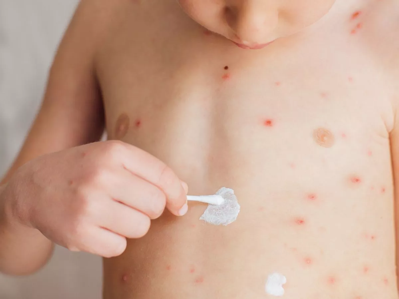 Bị thủy đậu kiêng gió không? 5