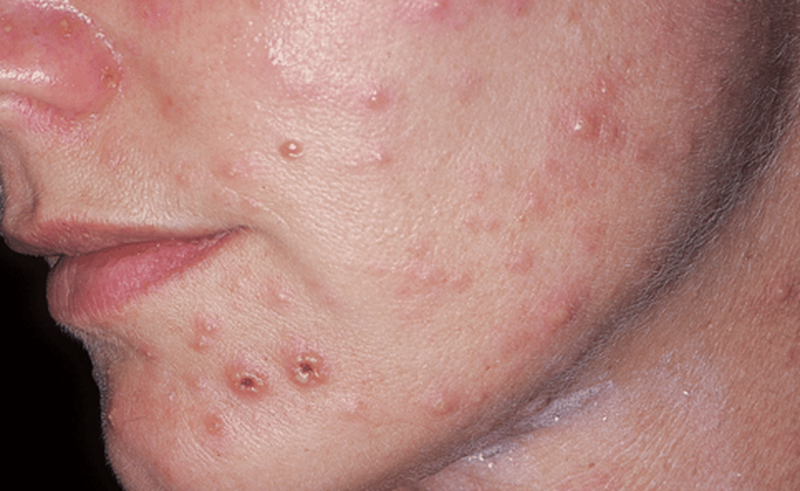 Bị thủy đậu mụn mủ có nguy hiểm không và cách xử lý 1