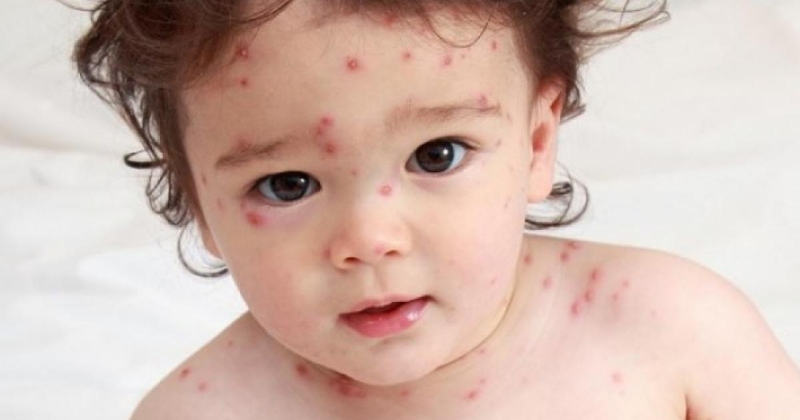 Liệu người bị thủy đậu rồi có bị lại không 1