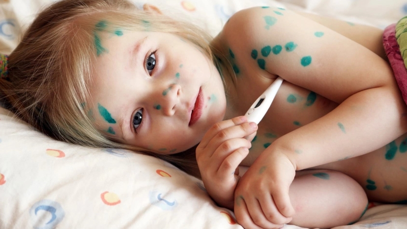Bị thủy đậu rồi có bị lại không? Cách điều trị bệnh thủy đậu 0