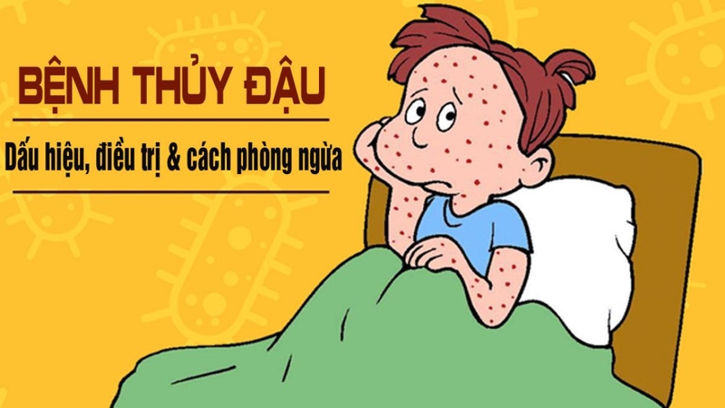 Bị thủy đậu rồi có bị zona nữa không 2