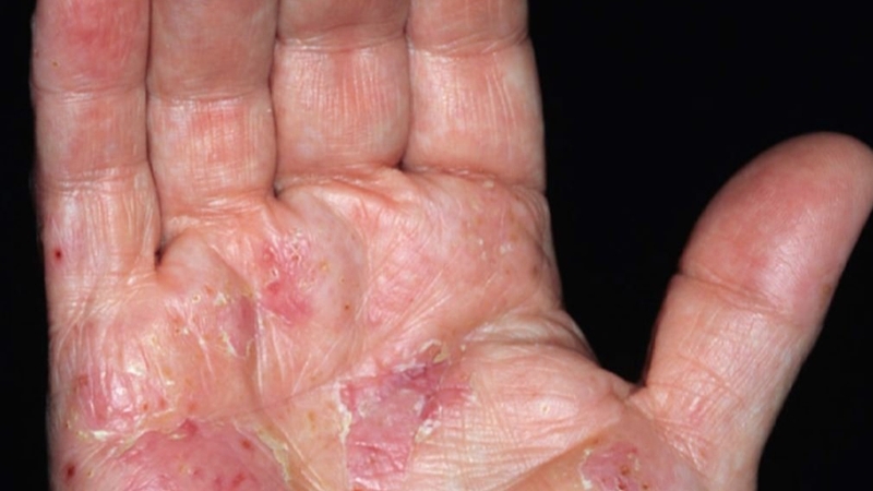 Bị tổ đỉa có lây không? Cách nhận biết và phòng tránh bệnh 2