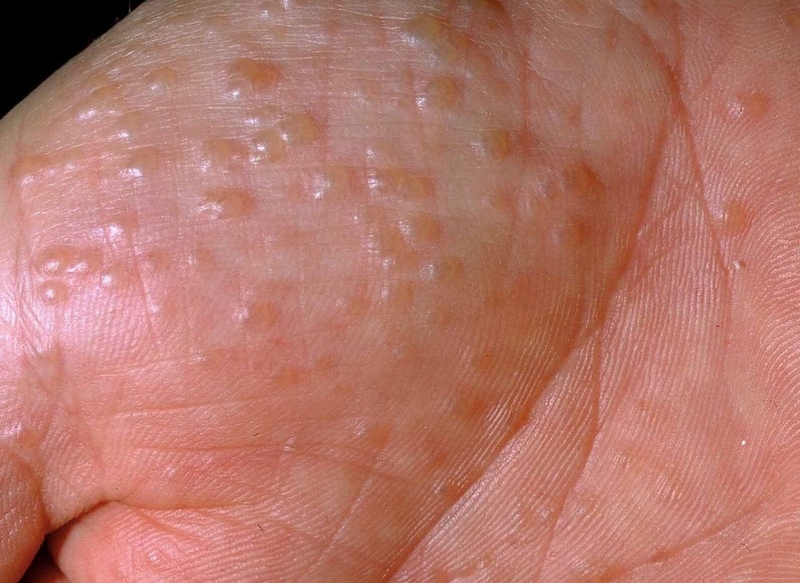 Bị tổ đỉa sau sinh: Làm sao để không còn là nỗi ám ảnh? 1