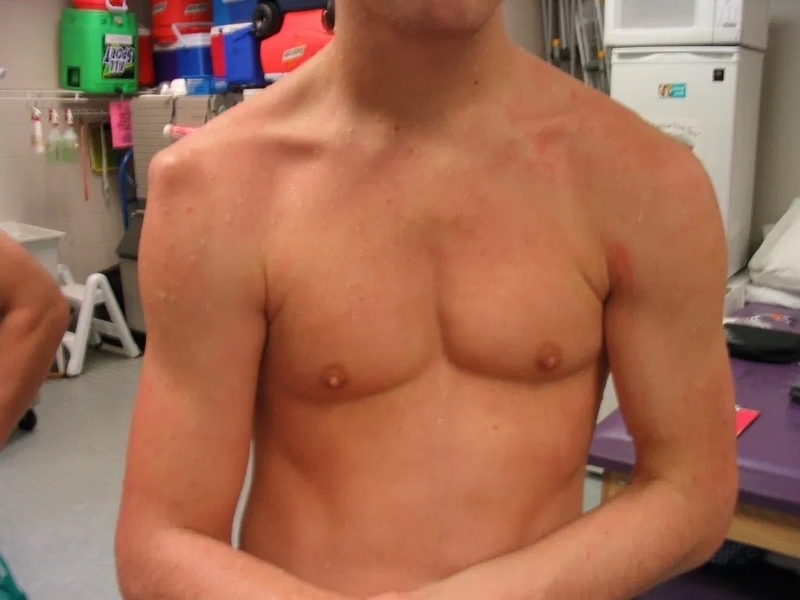 Bị trật khớp vai khi ngủ giải quyết như nào? 3