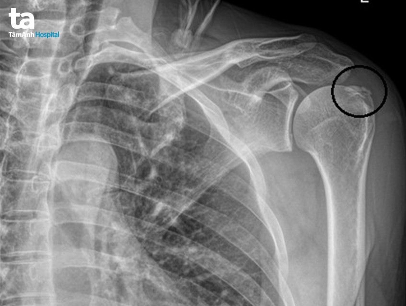 Bị trật khớp vai khi ngủ giải quyết như nào? 5