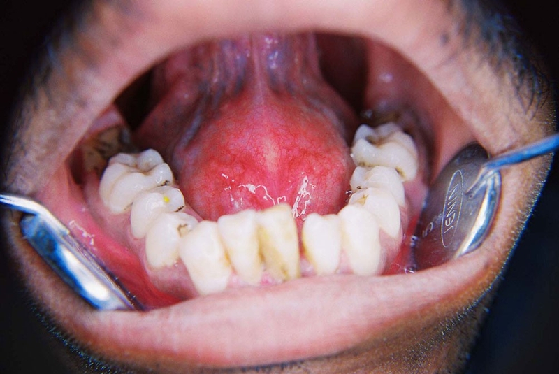 Bị u nang dưới lưỡi có nguy hiểm không? 1