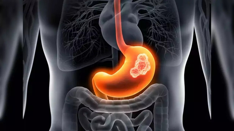 Bị ung thư dạ dày có chữa được không? Cách điều trị ung thư dạ dày 2