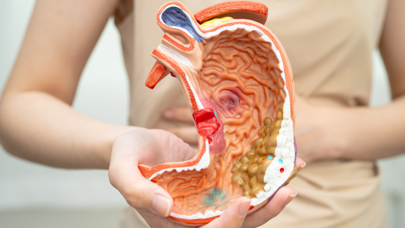 Ung thư dạ dày giai đoạn đầu sống được bao lâu? Nếu phát hiện bệnh ở giai đoạn sớm có tỉ lệ sống sót sau 5 năm lên tới khoảng 57% đến 71%