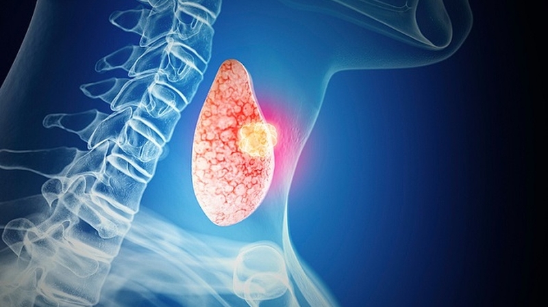 Bị ung thư tuyến giáp có ăn được thịt gà không? 3