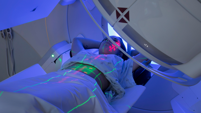 Xạ trị thường được thực hiện sau phẫu thuật bảo tồn vú nhằm tiêu diệt các tế bào ung thư còn sót lại