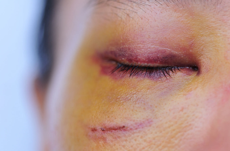 Bị vật nhọn chọc vào mắt thì xử lý như thế nào?