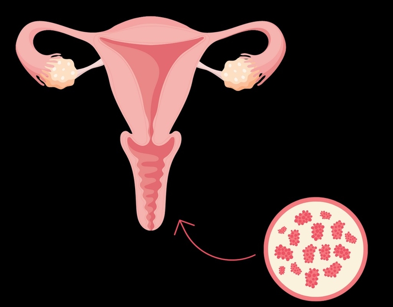 Bị viêm phụ khoa khi mang thai 3 tháng đầu có sao không? 3
