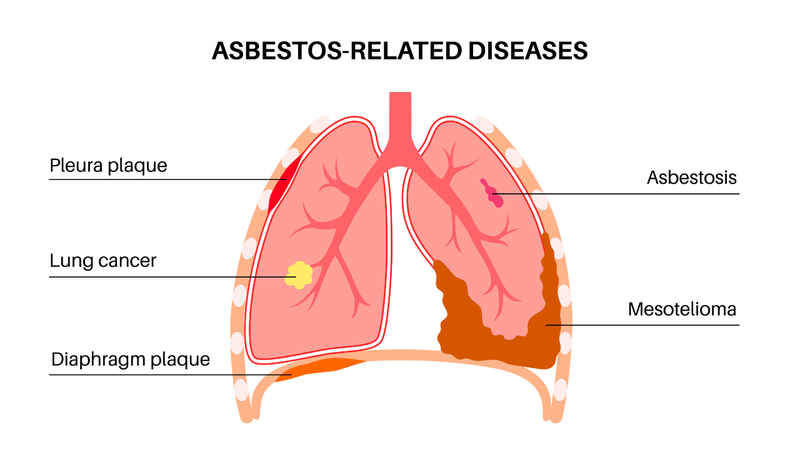 Bị xơ phổi làm tăng nguy cơ cao phát triển ung thư phổi