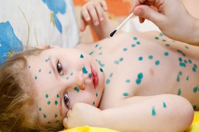 Bị zona bôi xanh methylen có được không? Cách bôi thuốc methylen sao cho hiệu quả 2