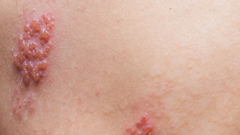 Bị zona có nổi hạch không? Giải đáp chuyên sâu từ chuyên gia y tế 1