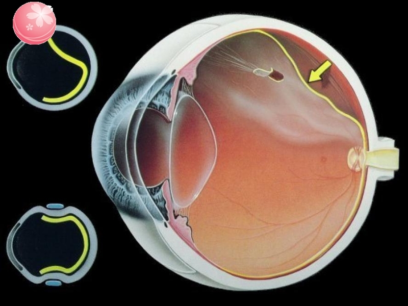 Biến chứng bong võng mạc khi bị cận thị nặng