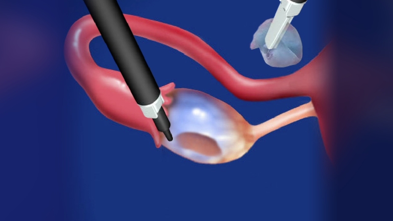 Biến chứng của cắt u nang buồng trứng 6