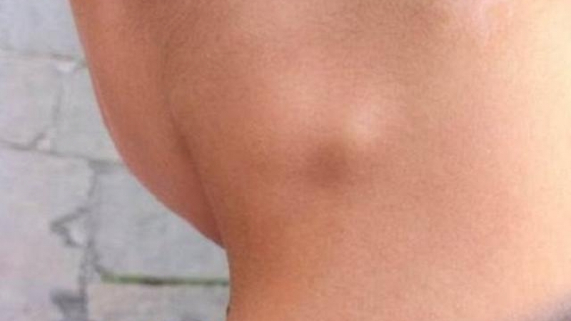 Biến chứng của lao hạch qua từng giai đoạn 1