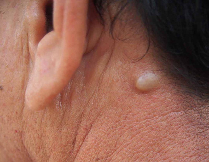 Biến chứng của lao hạch qua từng giai đoạn 2