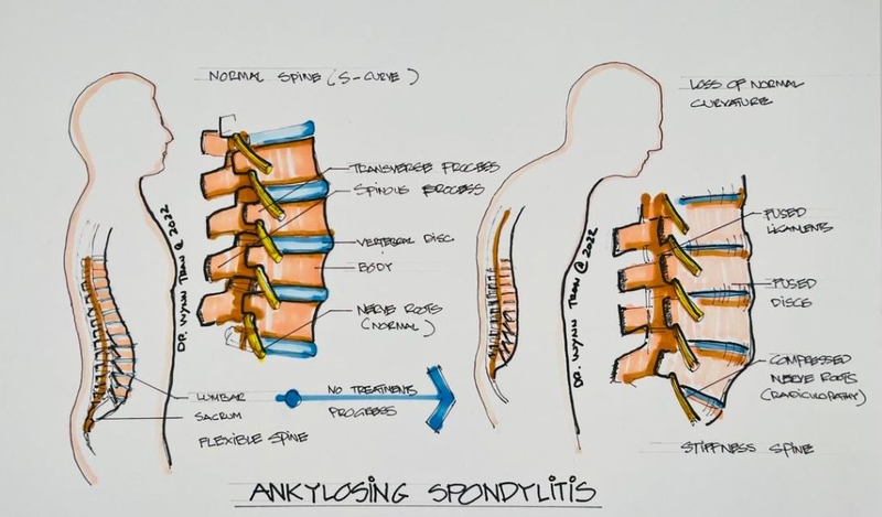 Biến chứng của viêm cột sống dính khớp và cách điều trị 1