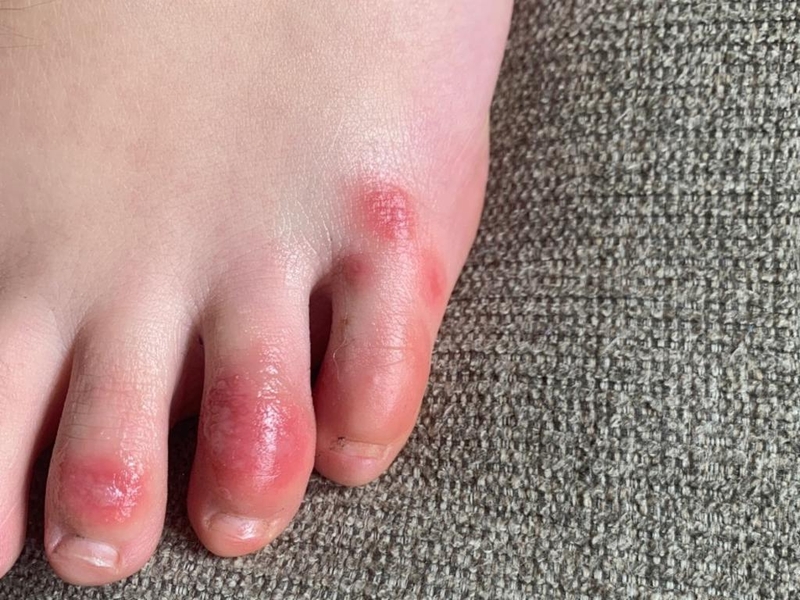 Biến chứng đông máu mới do nhiễm COVID-19 1