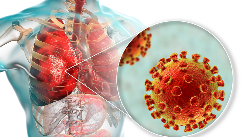 Viêm phổi là biến chứng tiến triển nhanh ở người mắc ho gà