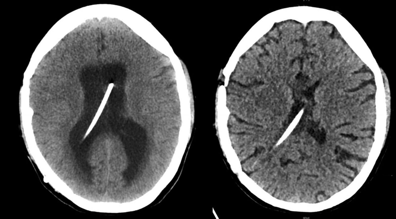 Biến chứng não úng thủy nguy hiểm thế nào? Cách điều trị não úng thủy phổ biến hiện nay 5