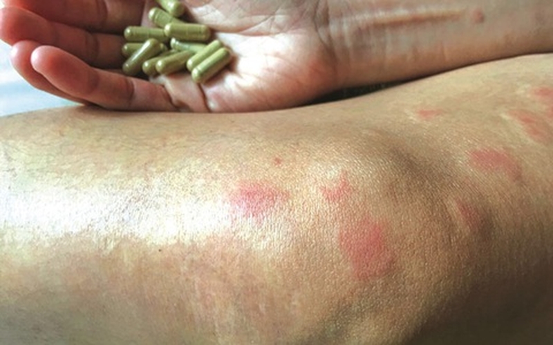 Biến chứng nguy hiểm: Lupus ban đỏ biến chứng huyết học3