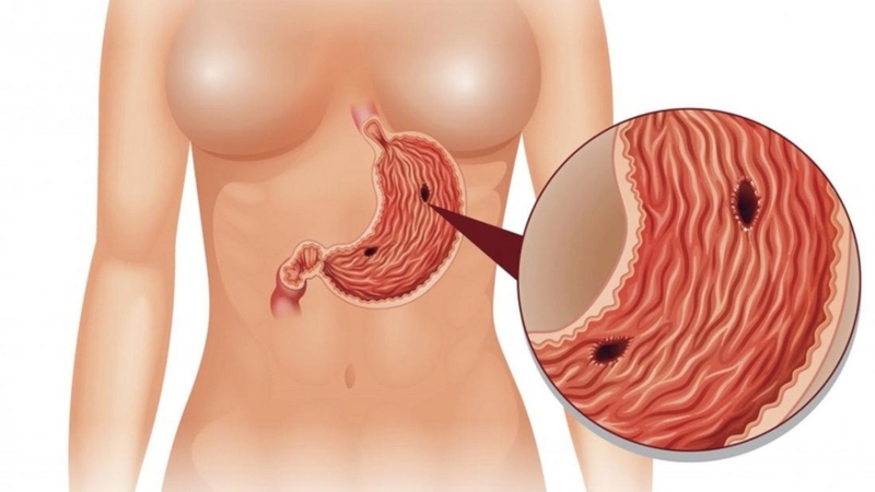 Thủng dạ dày là biến chứng hiếm gặp nhưng nghiêm trọng sau cắt polyp dạ dày