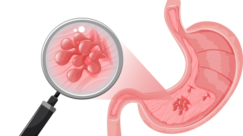 Bạn vẫn có nguy cơ tái phát polyp sau cắt polyp dạ dày